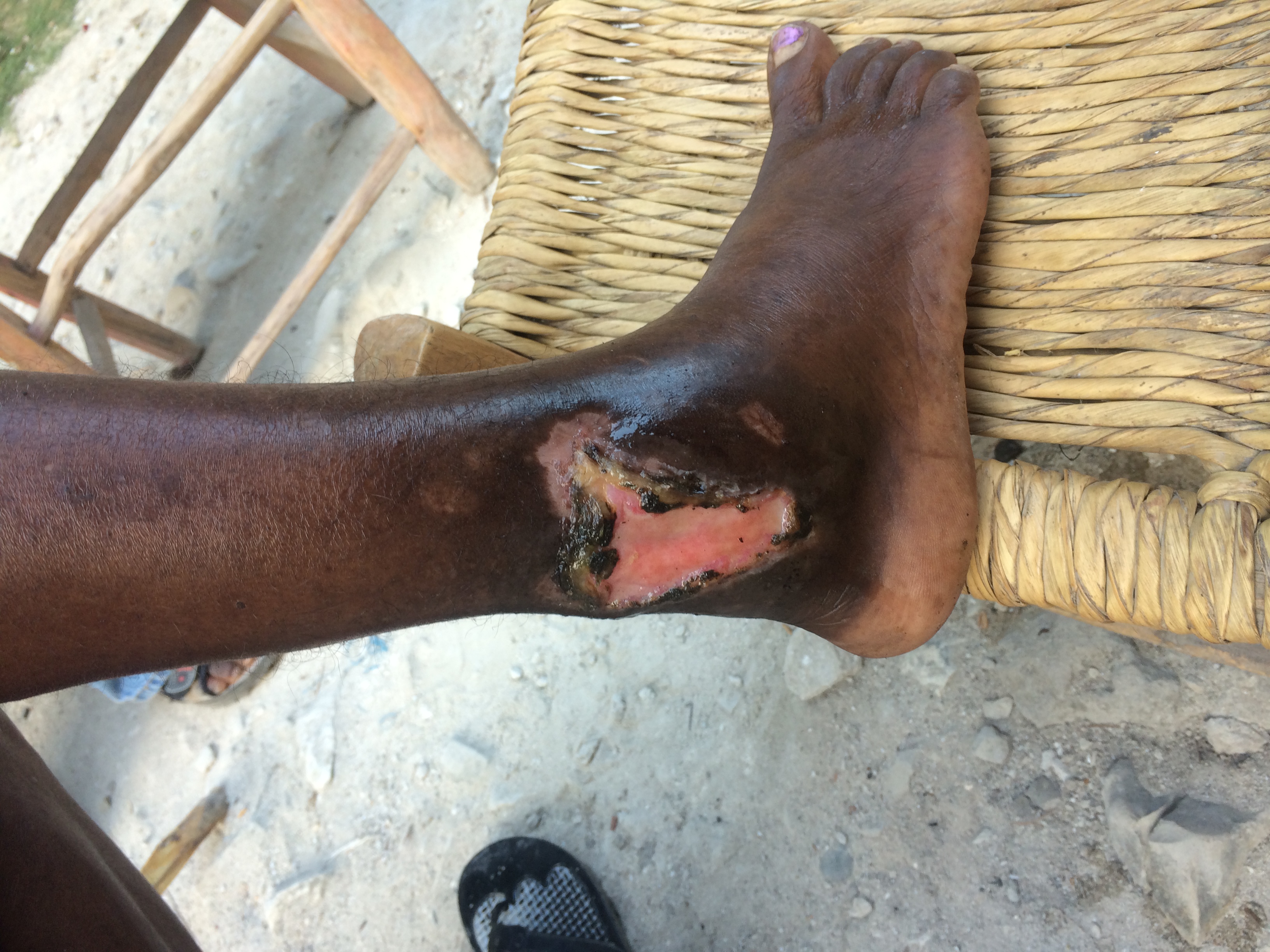 A woman's infected foot after Bill cleaned it up.