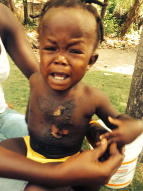 Poor baby burned with boiling water